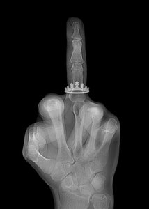 X-ray Mid Finger black and white- crown